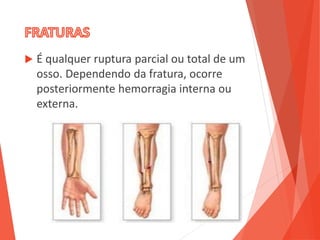  É qualquer ruptura parcial ou total de um
osso. Dependendo da fratura, ocorre
posteriormente hemorragia interna ou
externa.
 