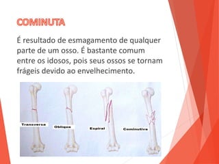 É resultado de esmagamento de qualquer
parte de um osso. É bastante comum
entre os idosos, pois seus ossos se tornam
frágeis devido ao envelhecimento.
 