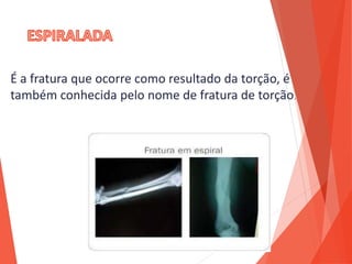 É a fratura que ocorre como resultado da torção, é
também conhecida pelo nome de fratura de torção.
 