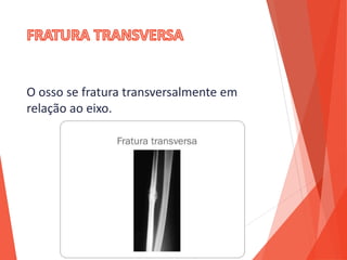 O osso se fratura transversalmente em
relação ao eixo.
 