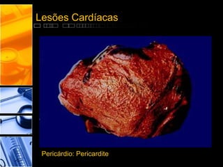 Lesões Cardíacas
Pericárdio: Pericardite
 