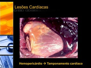 Lesões Cardíacas
Hemopericárdio  Tamponamento cardíaco
 