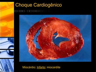 Choque Cardiogênico
Miocárdio: Infarto; miocardite
 