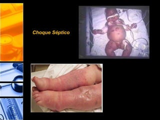 Choque Séptico
 