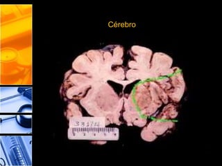 Cérebro
 