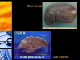 Baço Normal
Baço Anêmico
 