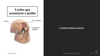 Lesões que
acometem o joelho
Condromalácia patelar
20/06/2017 Biomecânica do Joelho 22
 