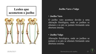 Lesões que
acometem o joelho
Joelho Varo e Valgo
• Joelho Varo
O joelho varo acontece devido a uma
alteração fisiológica, onde os joelhos se
afastam e os pés se juntam formando uma
abertura interna.
• Joelho Valgo
Alteração fisiológica, onde os joelhos se
juntam e os pés se afastam formando uma
abertura externa.
2520/06/2017 Biomecânica do Joelho
 
