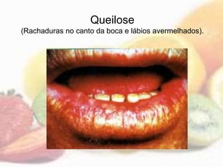 Queilose
(Rachaduras no canto da boca e lábios avermelhados).
 