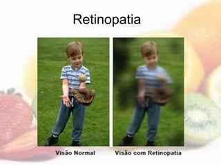 Retinopatia
 