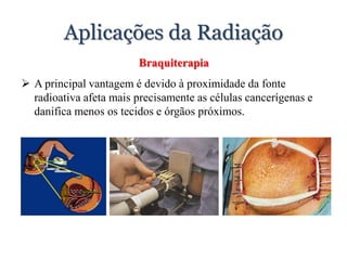 Aplicações da Radiação
Braquiterapia
 A principal vantagem é devido à proximidade da fonte
radioativa afeta mais precisamente as células cancerígenas e
danifica menos os tecidos e órgãos próximos.
 