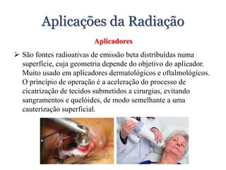 Aplicações da Radiação
Aplicadores
 São fontes radioativas de emissão beta distribuídas numa
superfície, cuja geometria depende do objetivo do aplicador.
Muito usado em aplicadores dermatológicos e oftalmológicos.
O princípio de operação é a aceleração do processo de
cicatrização de tecidos submetidos a cirurgias, evitando
sangramentos e quelóides, de modo semelhante a uma
cauterização superficial.
 