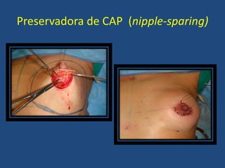 Preservadora de CAP (nipple-sparing)
 