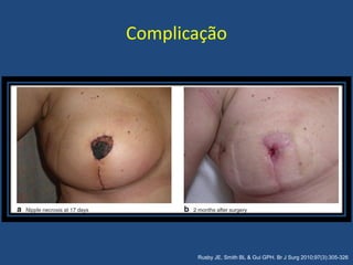 Rusby JE, Smith BL & Gui GPH. Br J Surg 2010;97(3):305-326
Complicação
 