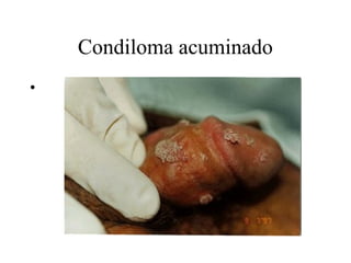 Condiloma acuminado
•
 