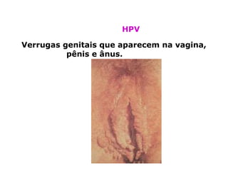 HPV

Verrugas genitais que aparecem na vagina,
          pênis e ânus.
 