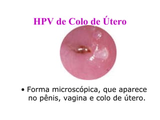 HPV de Colo de Útero




• Forma microscópica, que aparece
  no pênis, vagina e colo de útero.
 