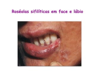 Roséolas sifilíticas em face e lábio
 