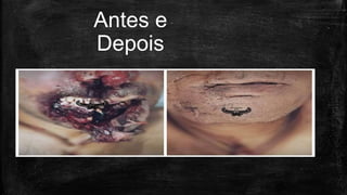 Antes e
Depois
 