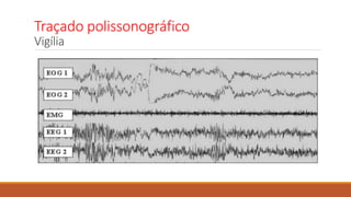 Traçado polissonográfico
Vigília
 