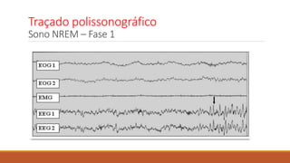 Traçado polissonográfico
Sono NREM – Fase 1
 