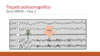Traçado polissonográfico
Sono NREM – Fase 2
K
Fusos
 