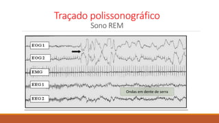 Traçado polissonográfico
Sono REM
Ondas em dente de serra
 