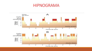 HIPNOGRAMA
 