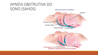 APNÉIA OBSTRUTIVA DO
SONO (SAHOS)
 