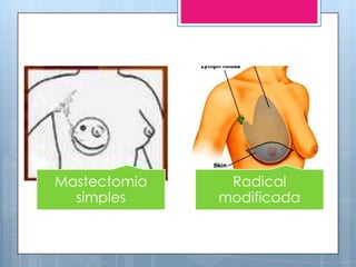 Mastectomia    Radical
  simples     modificada
 
