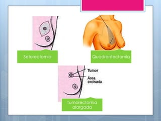 Seminário câncer de mama
