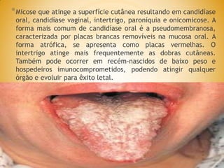 *Micose que atinge a superfície cutânea resultando em candidíase
oral, candidíase vaginal, intertrigo, paroníquia e onicomicose. A
forma mais comum de candidíase oral é a pseudomembranosa,
caracterizada por placas brancas removíveis na mucosa oral. A
forma atrófica, se apresenta como placas vermelhas. O
intertrigo atinge mais frequentemente as dobras cutâneas.
Também pode ocorrer em recém-nascidos de baixo peso e
hospedeiros imunocomprometidos, podendo atingir qualquer
órgão e evoluir para êxito letal.
 