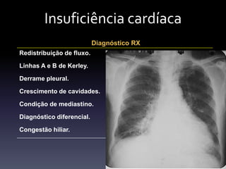 Insuficiência cardíaca
                           Diagnóstico RX
Redistribuição de fluxo.

Linhas A e B de Kerley.

Derrame pleural.

Crescimento de cavidades.

Condição de mediastino.

Diagnóstico diferencial.

Congestão hiliar.
 