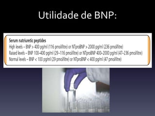 Utilidade de BNP:
 