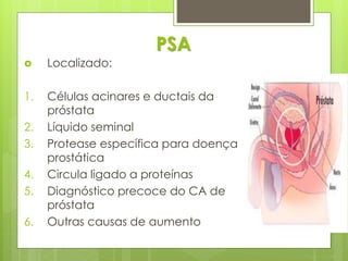 PSA 
 Localizado: 
1. Células acinares e ductais da 
próstata 
2. Líquido seminal 
3. Protease específica para doença 
prostática 
4. Circula ligado a proteínas 
5. Diagnóstico precoce do CA de 
próstata 
6. Outras causas de aumento 
 