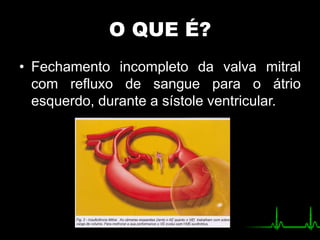 O QUE É?
• Fechamento incompleto da valva mitral
com refluxo de sangue para o átrio
esquerdo, durante a sístole ventricular.
 