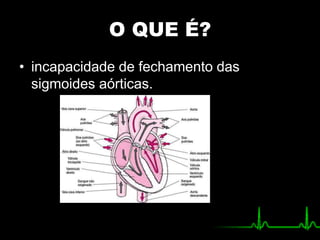 O QUE É?
• incapacidade de fechamento das
sigmoides aórticas.
 