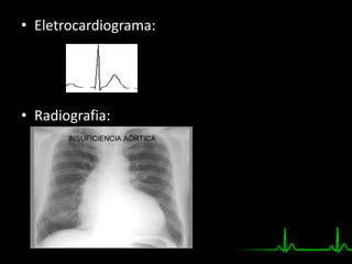 • Eletrocardiograma:
• Radiografia:
 