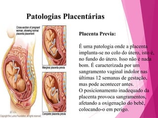 Patologias Placentárias
Placenta Previa:
É uma patologia onde a placenta
implanta-se no colo do útero, isto é,
no fundo do útero. Isso não é nada
bom. É caracterizada por um
sangramento vaginal indolor nas
últimas 12 semanas de gestação,
mas pode acontecer antes.
O posicionamento inadequado da
placenta provoca sangramentos,
afetando a oxigenação do bebê,
colocando-o em perigo.

 