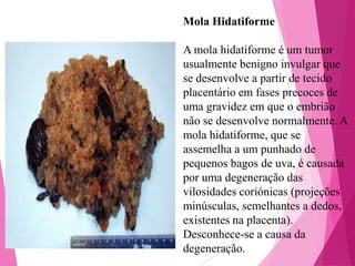 Mola Hidatiforme

A mola hidatiforme é um tumor
usualmente benigno invulgar que
se desenvolve a partir de tecido
placentário em fases precoces de
uma gravidez em que o embrião
não se desenvolve normalmente. A
mola hidatiforme, que se
assemelha a um punhado de
pequenos bagos de uva, é causada
por uma degeneração das
vilosidades coriónicas (projeções
minúsculas, semelhantes a dedos,
existentes na placenta).
Desconhece-se a causa da
degeneração.

 