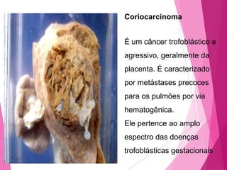 Coriocarcinoma

É um câncer trofoblástico e
agressivo, geralmente da
placenta. É caracterizado

por metástases precoces
para os pulmões por via
hematogênica.

Ele pertence ao amplo
espectro das doenças
trofoblásticas gestacionais

 