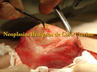 Neoplasias BBeenniiggnnaass ddee CCoolloo UUtteerriinnoo 
 