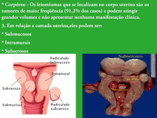 • Corpóreo - Os leiomiomas que se localizam no corpo uterino são os 
tumores de maior freqüência (91,2% dos casos) e podem atingir 
grandes volumes e não apresentar nenhuma manifestação clínica. 
3. Em relação a camada uterina,eles podem ser: 
• Submucosos 
• Intramurais 
• Subserosos 
 