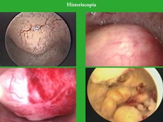 Histeriscopia 
 