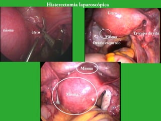 Histerectomia laparoscópica 
 