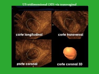 US tridimensional (3D) via transvaginal 
 