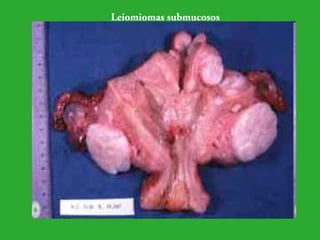 Leiomiomas submucosos 
 