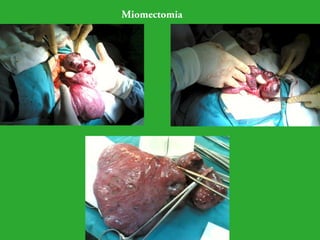 Miomectomia 
 