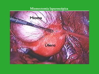 Miomectomia laparoscópica 
 
