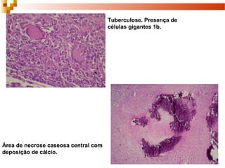 Área de necrose caseosa central com
deposição de cálcio.
Tuberculose. Presença de
células gigantes 1b.
 